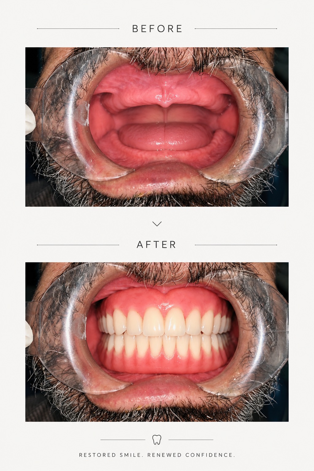 Before and after Denture